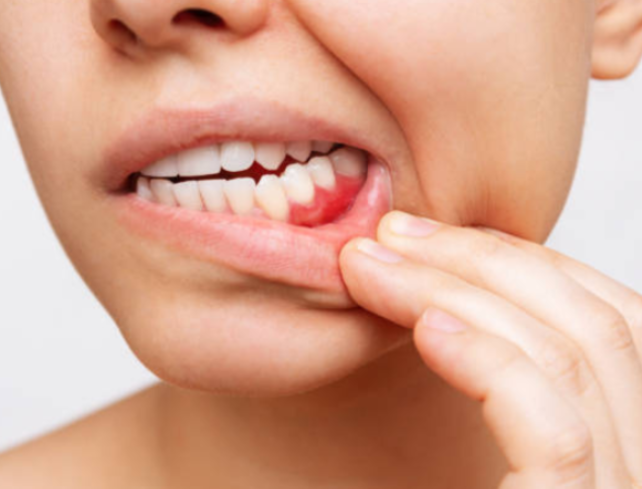 estudio-revela-conexion-peligrosa-entre-encias-enfermas-y-el-accidente-cerebrovascular