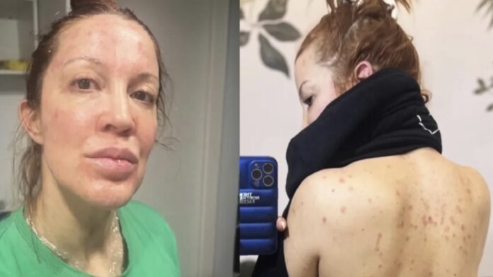 las-impactantes-fotos-y-el-duro-relato-de-miriam-lanzoni-sobre-el-drama-de-salud-que-vivio