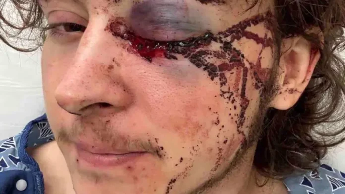 “los-medicos-dicen-que-estoy-vivo-de-milagro”:-el-joven-que-perdio-un-ojo-durante-una-protesta-contra-ice-en-california